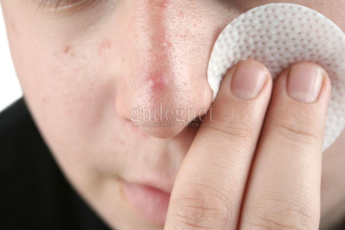 Tips Hindari dan Merawat ''Maskne'' Tips Hindari dan Merawat ''Maskne''