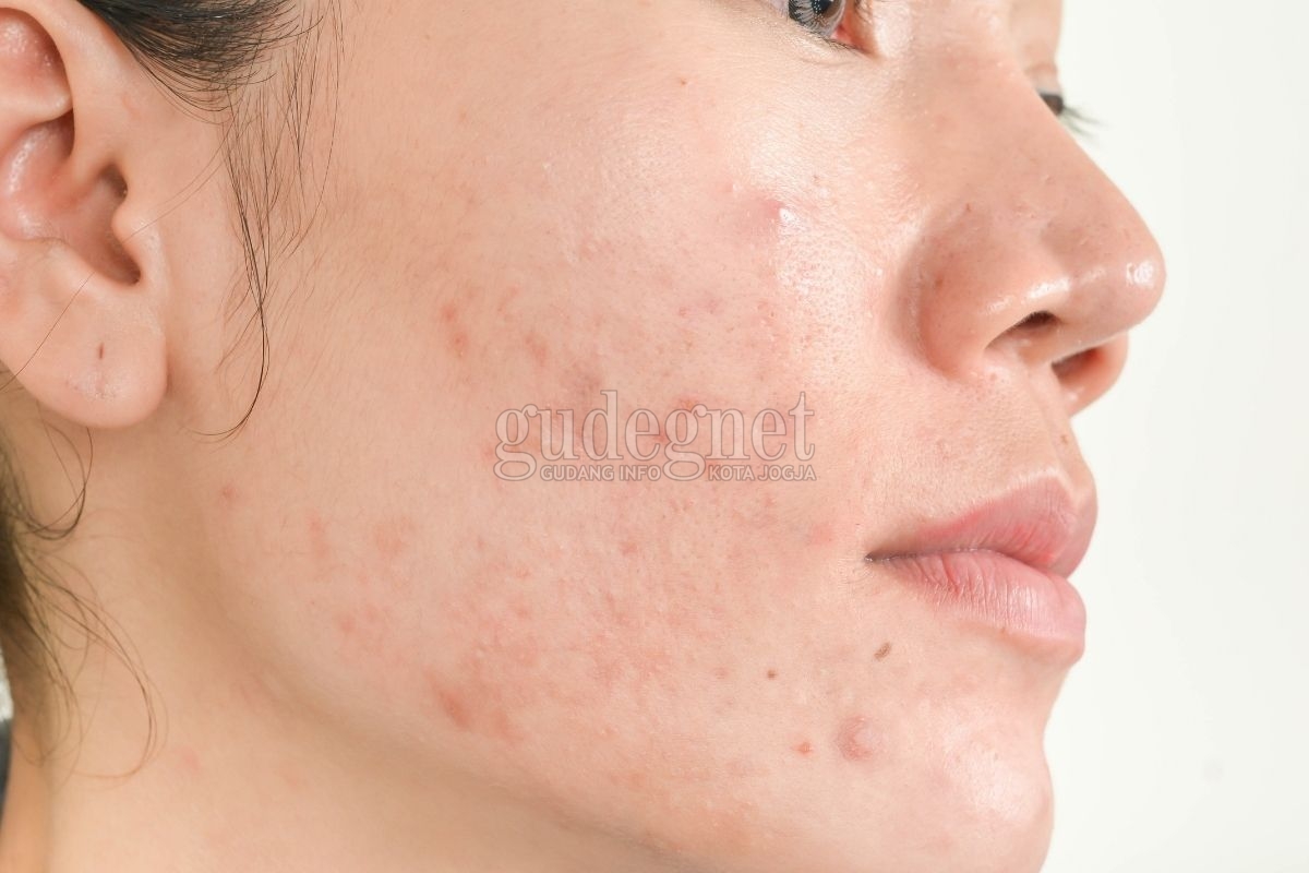 Hilangkan Bekas Jerawat dengan Bahan Rumahan Hilangkan Bekas Jerawat dengan Bahan Rumahan